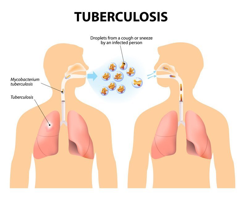 Tuberculosis (TB)